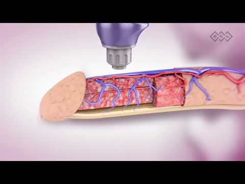Erectile Dysfunction Treatment with BTL Shockwave Therapy