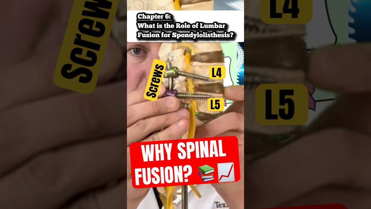 Why “Cages” in Spinal Fusion (Part 6)