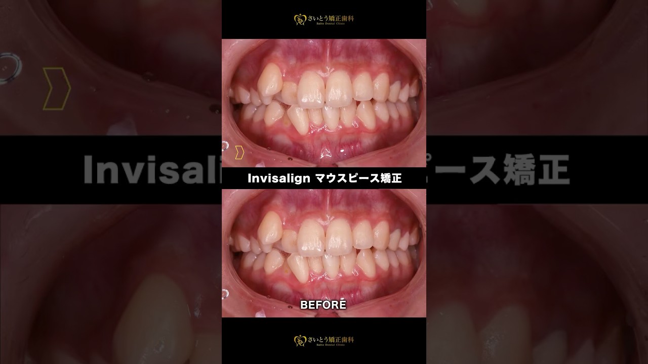 ワイヤーではなくマウスピース矯正したい方必見！#インビザライン #歯列矯正 #さいとう矯正歯科