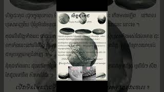 ដុះគុជ នឹង ដុះសាច់សិរមាន់ ខុសគ្នាដូម្តេច?