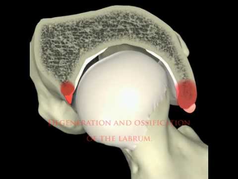 Pincer Impingement Explained