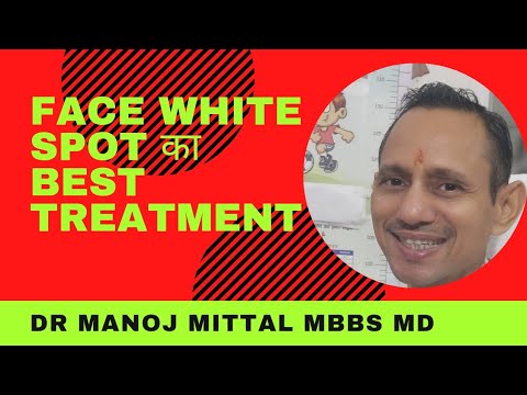 चहरे के सफेद दाग का BEST TREATMENT