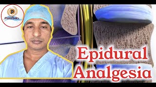 Epidural Analgesia(postoperative  pain management)#epidural#analgesia#postoperative #PainfixRx