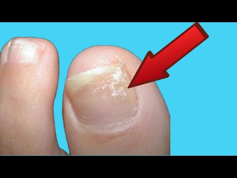 El aceite de coco a la psoriasis las revocaciones de los médicos El vegetarianismo a la psoriasis las revocaciones