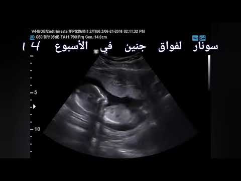 إحذري فواق الجنين أو ما يسمى بالشهقة أو الحازوقة حركات منتظمة مثل نبضات القلب hiccups baby