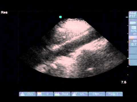 Ultrasound Evaluation of the Ab Aorta