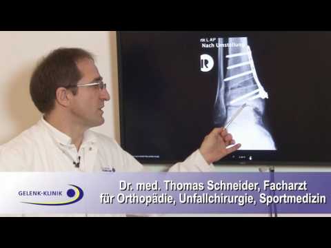 Klicken Gelenke Prävention Welche Übungen in Osteochondrose der HWS-Grafikkarte