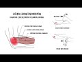 Tennis elbow - lateral elbow tendinopathy (lateral epicondylitis)