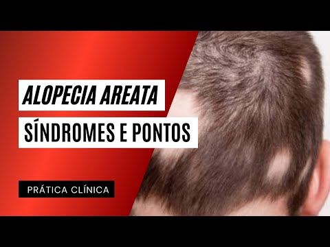 , title : 'Alopécia Areata - Síndromes e pontos'