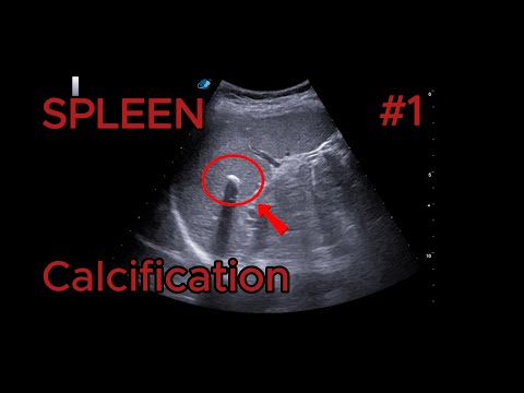 Splenic calcification with posterior shadowing video preview