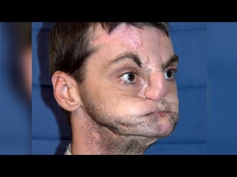 Woman Meets Man Who Received Her Brother's Face in Transplant