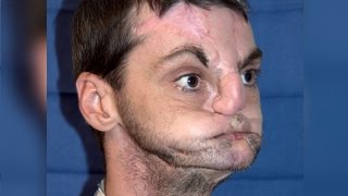 Woman Meets Man Who Received Her Brother&#39;s Face in Transplant