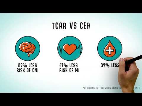 Transcarotid Artery Revascularization (TCAR) | Conemaugh Health System