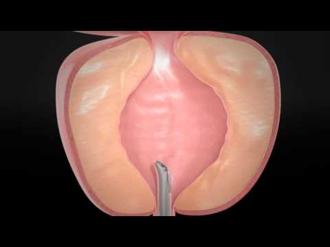 Eine große Anzahl von Kokken in dem Prostata Saft Palpation der Prostata-Adenom