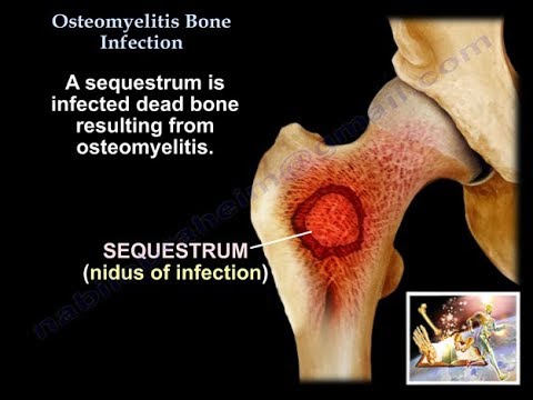 könyök osteomyelitis kezelés)