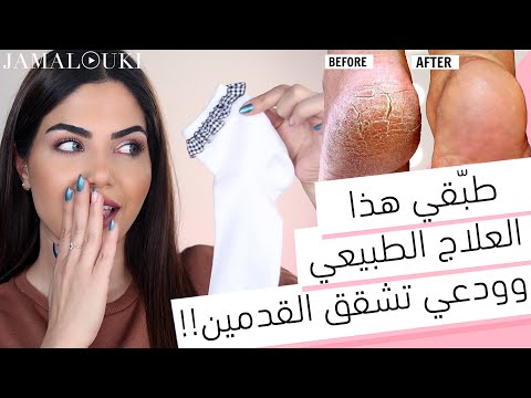 تشقق القدمين لم يعد مشكلة: علاج تشقق القدمين بخطوات منزلية مضمونة | العناية بالقدمين هنا hana