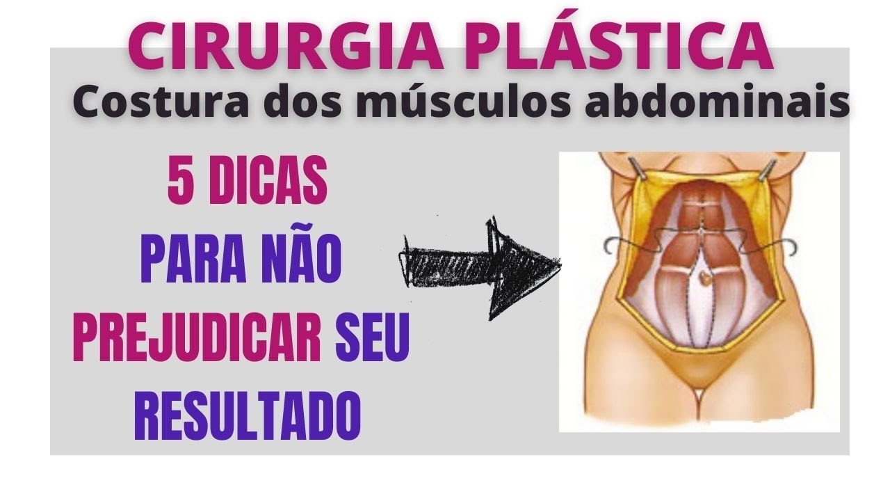 5 Dicas para quem vai fazer a costura dos músculos abdominais para não atrapalhar o resultado!