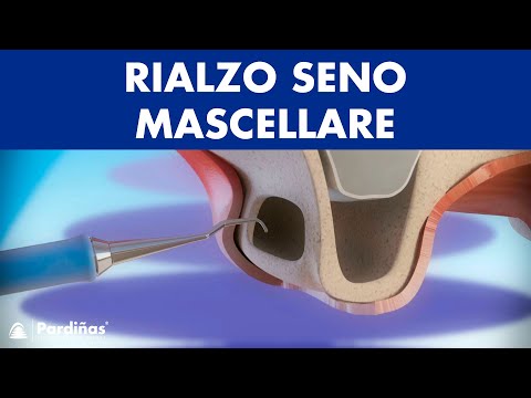 Rialzo seno mascellare ©