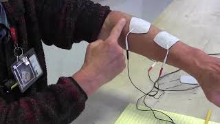 Stroke Rehabilitation: Use of electrical stimulation to help arm and hand recovery
