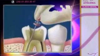 ¿Qué es una endodoncia? - Clínica Dental Apolonia