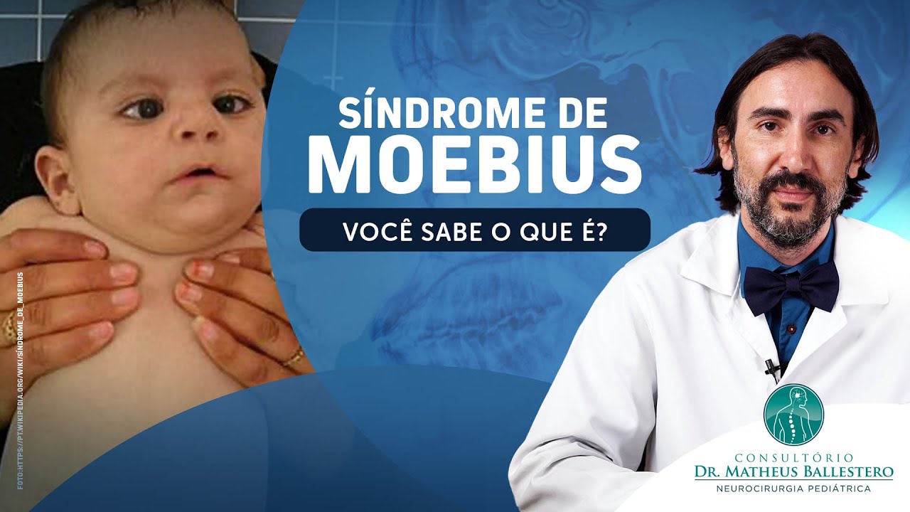 Síndrome de Moebius - Você sabe o que é?