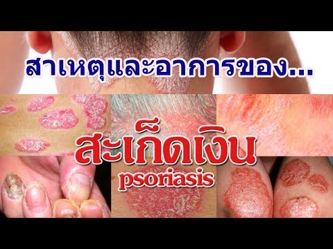 Lospra และโรคสะเก็ดเงิน ดูภาพถ่ายของโรคสะเก็ดเงิน
