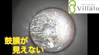 耳掃除動画vol.64「鼓膜が見えない」