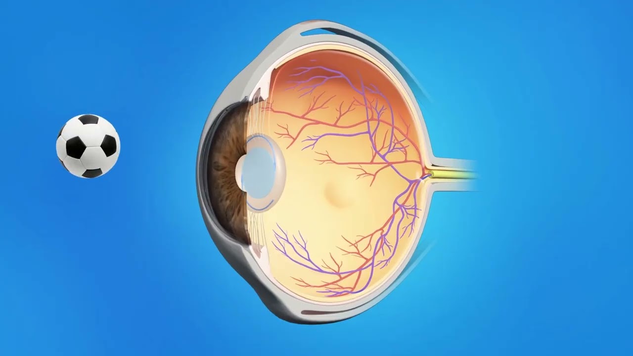 Cataract Femto with Toric Lens