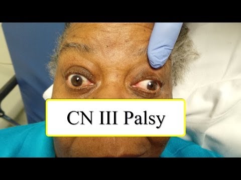 Paralysie du nerf cervical III