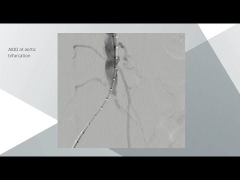 Case Study: Treating Severe Aortoiliac Occlusive Disease (AIOD) at the Aortic Bifurcation
