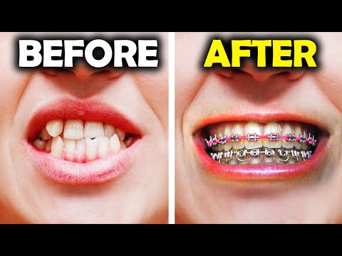 GETTING BRACES - Power Chain