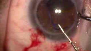 Malyugin ring placement (please view my other video)