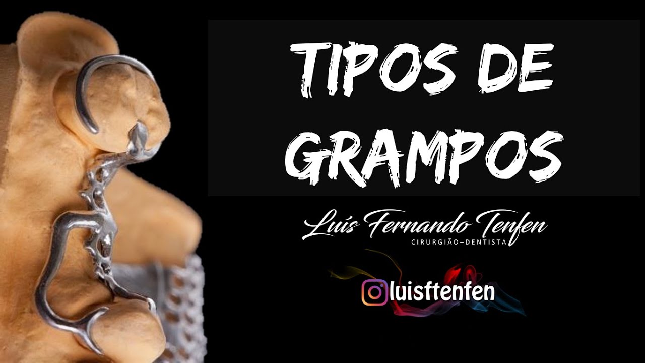 Prótese Parcial Removível #5: Tipos de Grampos