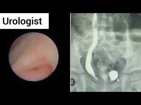( Cystoscopy (female child 3 y with left c-u reflex diverticulum and orface in it تنظير مثانة طفلة