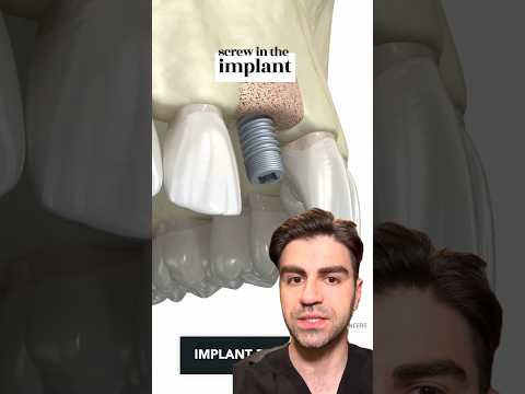 Tooth Implant Procedure {STEP BY STEP} - Explained