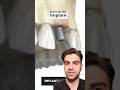 Tooth Implant Procedure {STEP BY STEP} - Explained