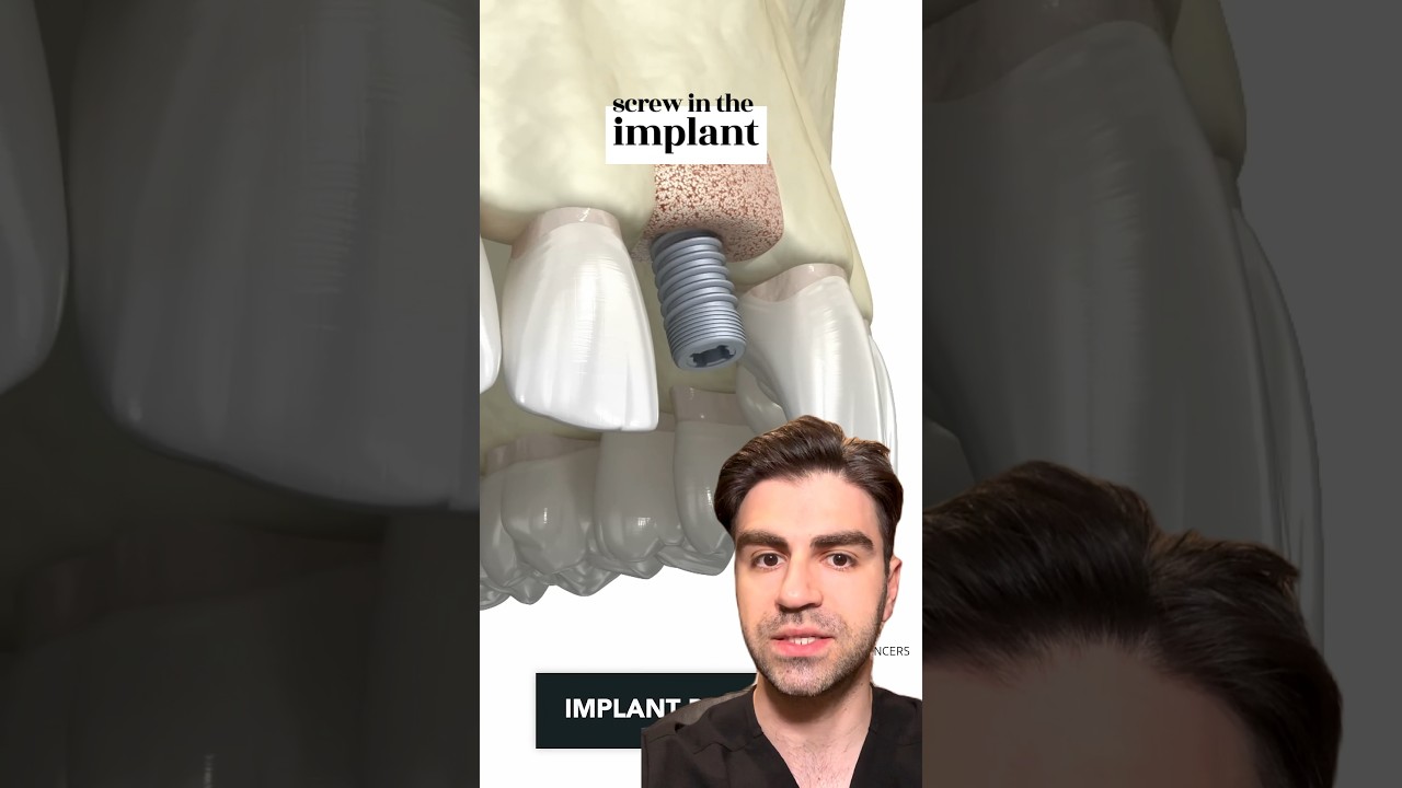 Tooth Implant Procedure {STEP BY STEP} - Explained