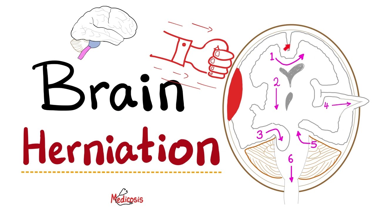 Brain Herniation - Uncal, Tonsillar, Cingulate, Transcalvarial, Trauma, Cerebral herniation - Neuro