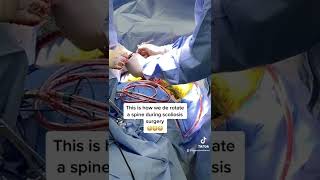 DeRotating a 75 degree Scoliosis Curve!