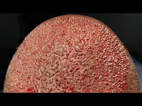 Hair Restoration Surgery