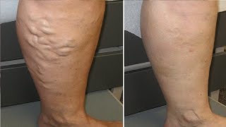 how to get rid of varicose veins naturally in 3 minutes
