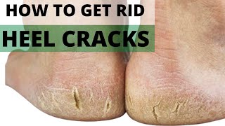 HOW TO GET RID OF HEEL CRACKS, DRY CRACKED HEELS & DRY SKIN