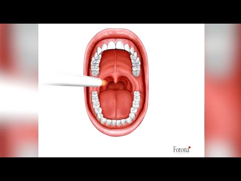 Web Exclusive: New treatment for snoring in Manhattan, Kansas