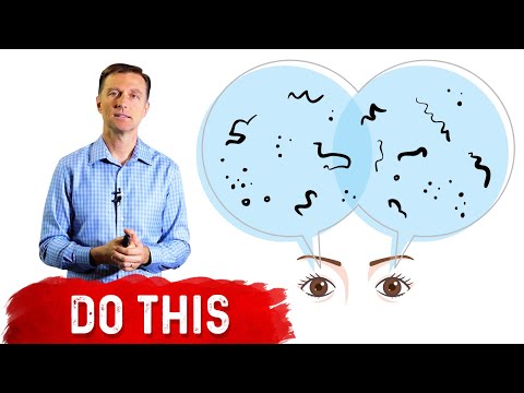 How To Get Rid of Eye Floaters – Dr Berg On Eye Floater Treatment