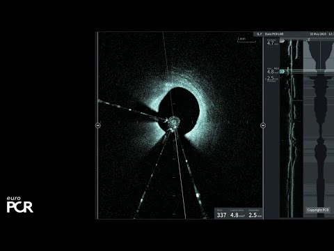 Left main and complex bifurcation stenting - EuroPCR 2025