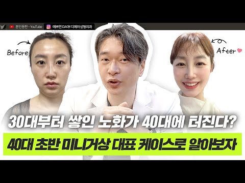 40대 미니거상 4단계, 강력 추천하는 이유는 이것입니다!ㅣ디에이성형외과ㅣ미니거상 4단계 케이스리뷰
