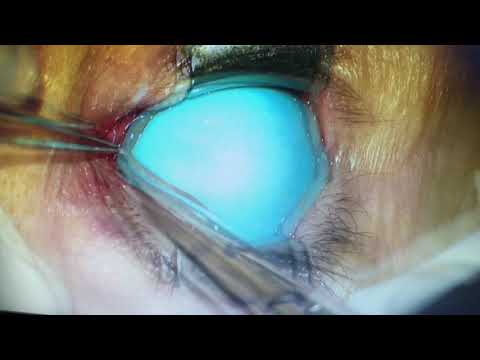 Canaliculotomía