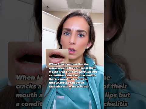 No amount of chapstick or licking of the lips will cure angular chelitis, in fact it may make it