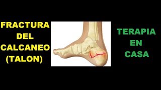Fractura del calcaneo / Terapia en casa