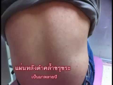 Celandine จากโรคสะเก็ดเงินบนหัว แชมพู 911 น้ำมันดินใน seborrhea โรคสะเก็ดเงินรังแค 150 มล.